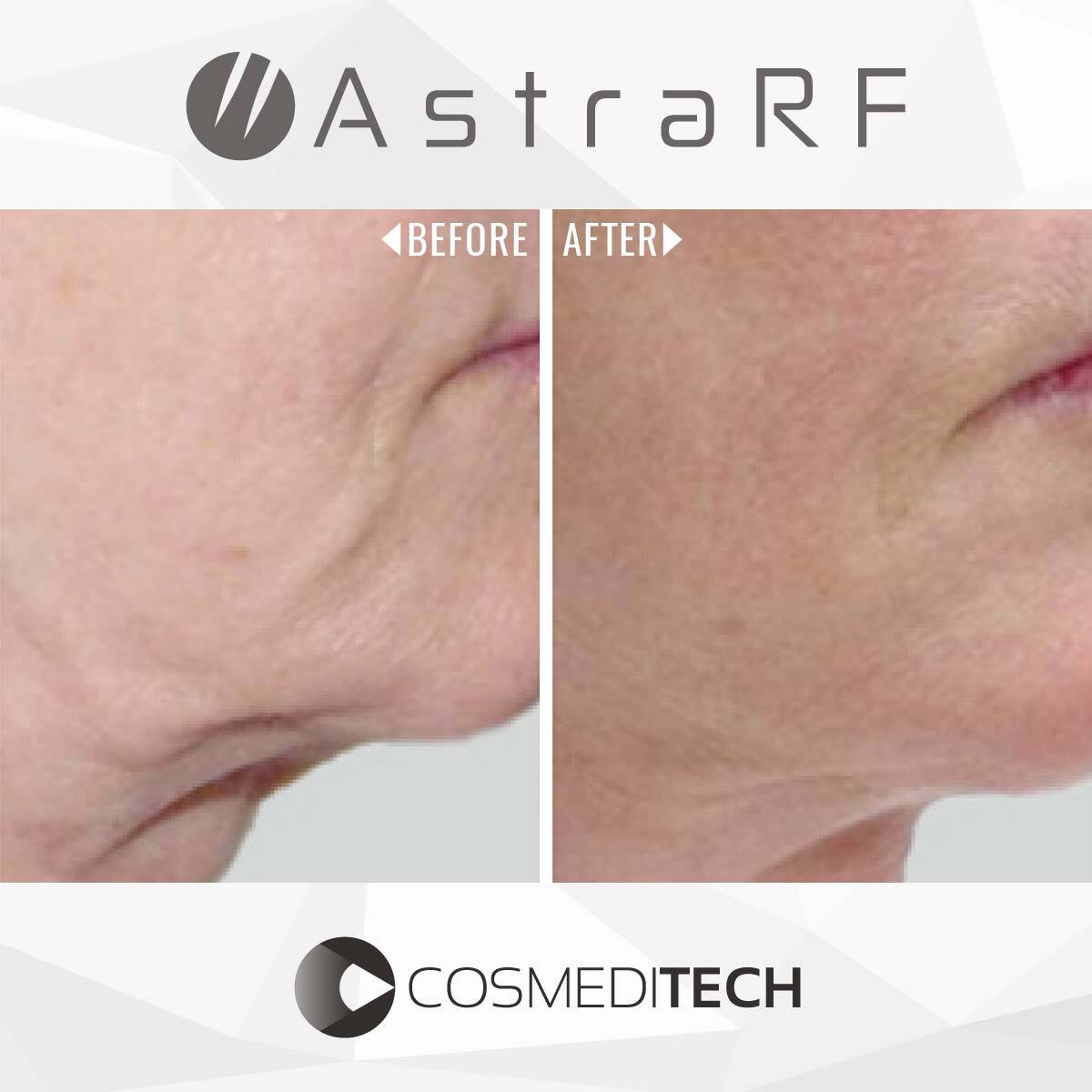 RF Microneedling